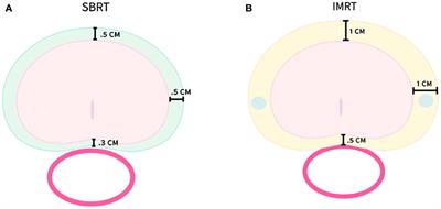 Intensity modulated radiation therapy with stereotactic body radiation therapy boost for unfavorable prostate cancer: five-year outcomes